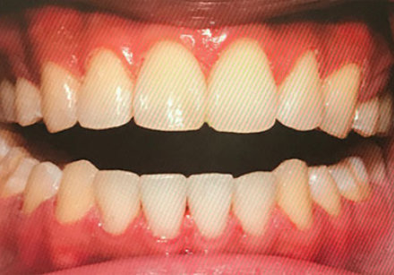 Close-up of a person's open mouth showing both upper and lower teeth with noticeable gap between the front upper and lower teeth.