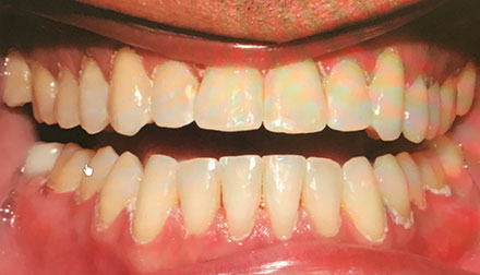 Close-up of a person's mouth showing upper and lower teeth, with some teeth misaligned and mild discoloration visible.