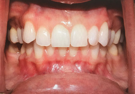 Close-up of an open mouth showing teeth and gums with visible irritation and redness on the upper and lower gums.