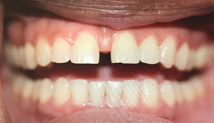 Close-up of a person's mouth showing teeth with a visible gap between the two upper front teeth.