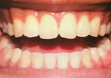 A close-up of an open mouth showing upper and lower teeth, with slight misalignment and visible gums.