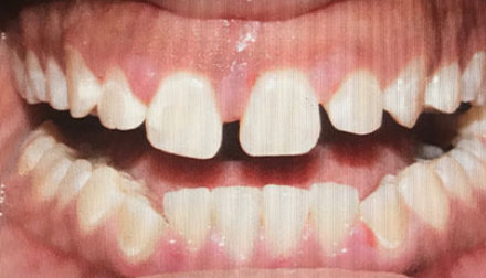 Close-up of a person's open mouth showing misaligned teeth with noticeable gaps between the upper front teeth.